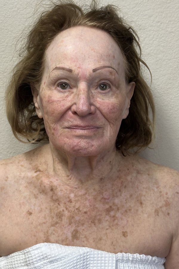 Client after buccal massage treatment in Woodland Hills