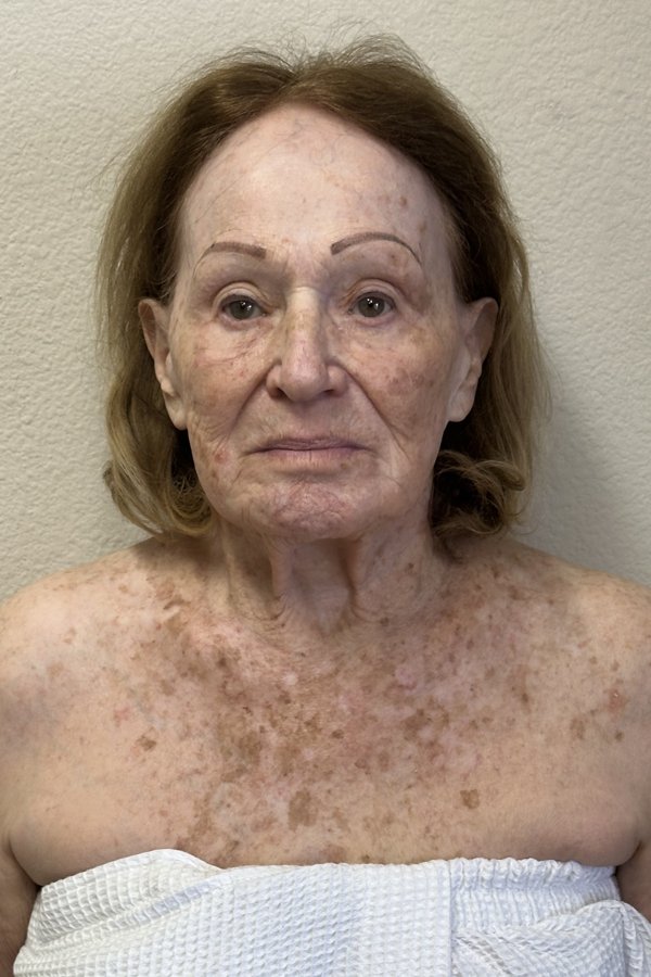 Client before buccal massage treatment in Woodland Hills